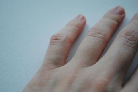 Uz mazā pirkstiņa parādījās artrītisks kamols. 