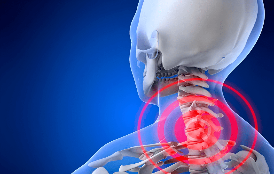 mugurkaula kakla daļas osteohondroze