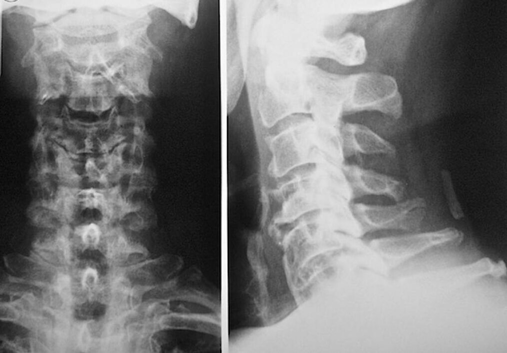 mugurkaula kakla rentgenogrāfija ar osteohondrozi