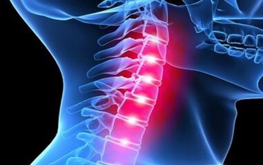 Mugurkaula kakla mugurkaula osteohondrozes simptomi
