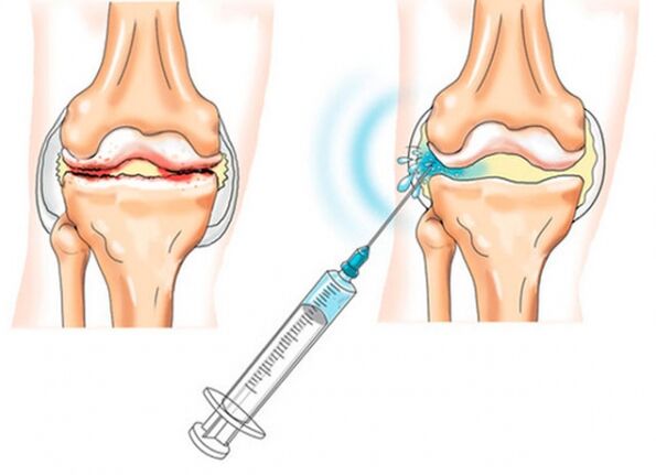 intraartikulāras injekcijas ceļa locītavas artrozes gadījumā