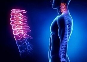 Dzemdes kakla osteohondrozes attīstības iemesli