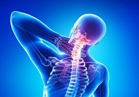 Iespējamas komplikācijas ar osteohondrozes krustojumu