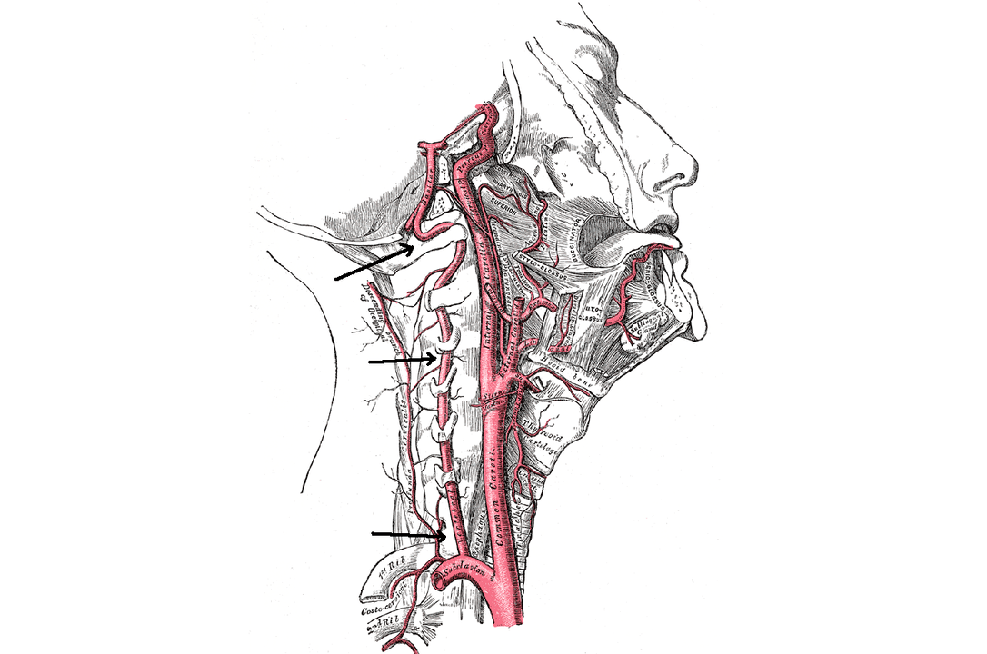 mugurkaula artērijas saspiešana ar dzemdes kakla osteohondrozi