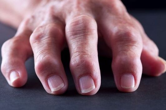 Pirkstu locītavu deformācijas artrozes vai artrīta dēļ